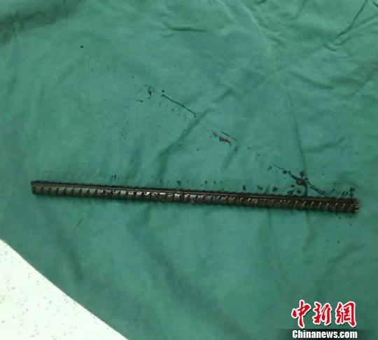 一米余長鋼筋穿破工人腹部 醫生消防協力挽回生命 一米余長鋼筋穿破工人腹部 醫生消防協力挽回生命