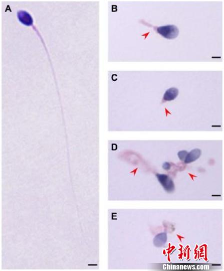 中美學者發現男性不孕不育新致病基因 中美學者發現男性不孕不育新致病基因