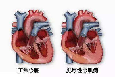 年輕人猝死多因這種心臟病！醫生提醒：一人發病全家篩查