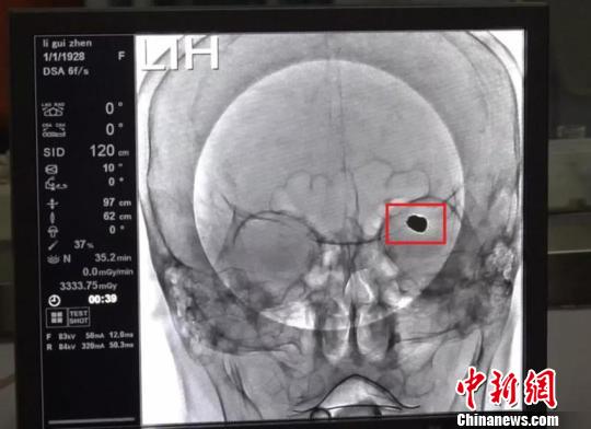 九旬老人腦部長“巨型”動脈瘤 醫生拆除“不定時炸彈” 九旬老人腦部長“巨型”動脈瘤 醫生拆除“不定時炸彈”