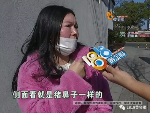 動了三次刀 患者：湖州曙光醫療美容醫院把我鼻子做的跟豬一樣