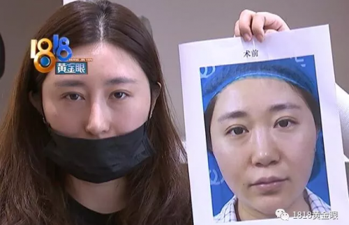 杭州華山連天美整形醫院把我鼻子做歪了 整的像阿凡達
