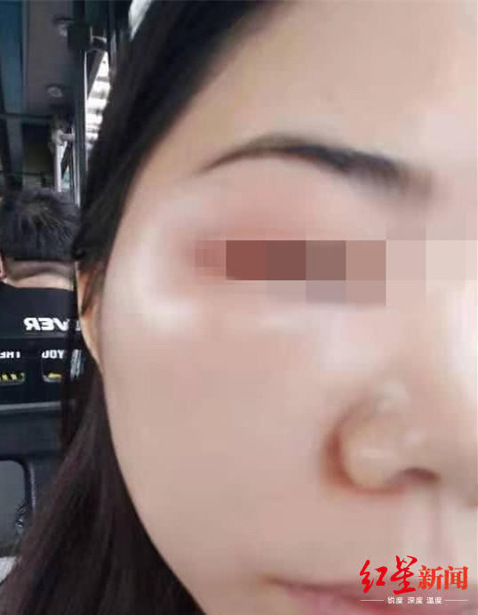 女子在宜賓韓美整形后差點(diǎn)毀容 醫(yī)院：個(gè)體差異