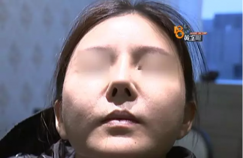 在寧波益寶醫療美容醫院整形后鼻孔就沒通暢過 院方：需證明不通與整形有關