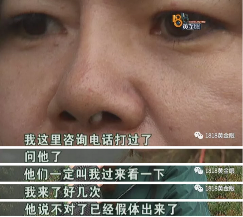 六年前在寧波珈禾整形專科醫院做隆鼻 現在鼻子不舒服露出白色假體-易網<a href=http://m.aoa7937.com/ target=_blank class=infotextkey>健康養生</a>網 六年前在寧波珈禾整形專科醫院做隆鼻 現在鼻子不舒服露出白色假體