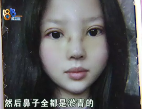 女子在嘉興長紅門診部整形后整個人都崩潰了 姑娘采訪從頭哭到尾