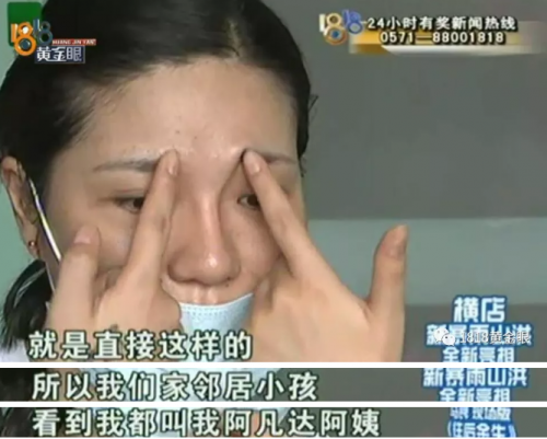 女子在紹興華美整形醫(yī)院整形后眼睛有異物感 鼻子也被整成像阿凡達