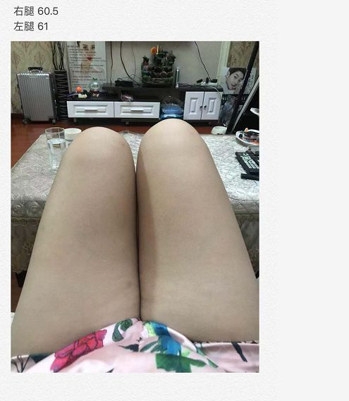 南昌亞太醫療美容醫院抽脂手術后情況很糟糕 女子維權卻被罵出來