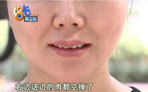 杭州維多利亞醫(yī)療美容醫(yī)院溶脂術(shù)后不如從前好看 整個(gè)人顯得很憔悴