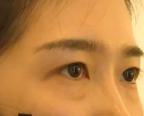 女子在杭州珈禾整形美容醫(yī)院打熊貓針結(jié)果變成熊貓眼？