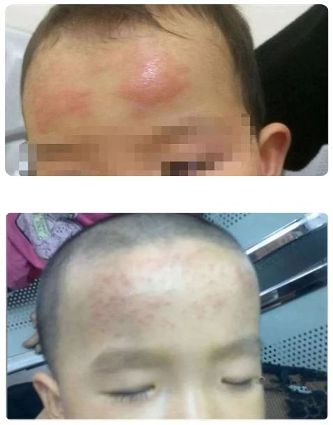 網紅退熱貼真這么神奇嗎？只能物理降溫 有的孩子出現過敏表現