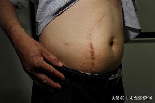 13年前只在洛陽市商業(yè)職工醫(yī)院做過一次闌尾手術 為何膽囊不見了？