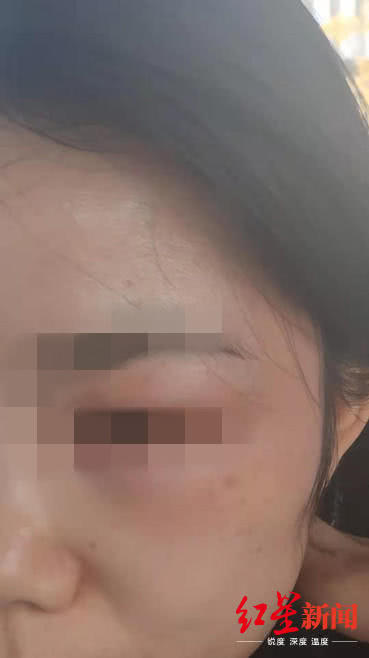女子在宜賓韓美整形后差點(diǎn)毀容 醫(yī)院：個(gè)體差異