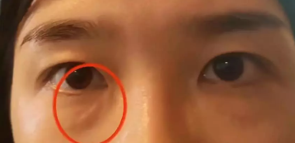 女子在杭州珈禾整形美容醫(yī)院打熊貓針結(jié)果變成熊貓眼？