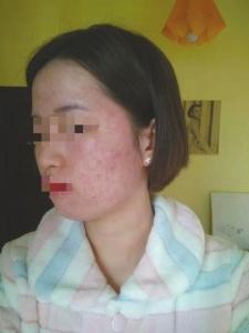 成都蕾特恩專業(yè)祛痘怎么樣？推銷陷阱多 81名消費者集體控訴蕾特恩