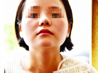泉州東大整形醫(yī)院被投訴：女子花4.4萬(wàn)整容 鼻子歪成這樣