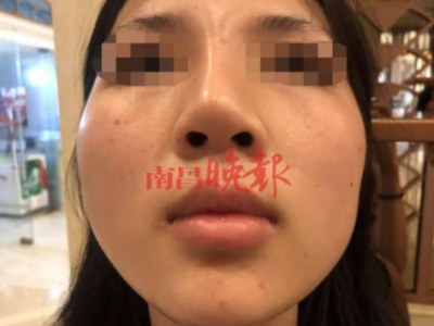 南昌禾麗整形醫(yī)院把我鼻子整歪了 記者介入?yún)f(xié)調(diào)才同意免費(fèi)修復(fù)