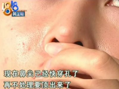 杭州麗星整形醫(yī)院整壞了鼻子至妍醫(yī)療美容來修復(fù) 醫(yī)院更名了？