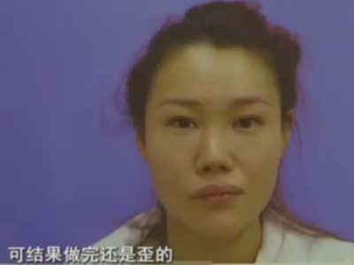 杭州格萊美整形醫(yī)院把美女鼻子成了S型 只敢開美顏拍照