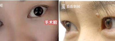 貴陽聚星妍美整形機構又出問題了 雙眼皮整成了單眼皮？