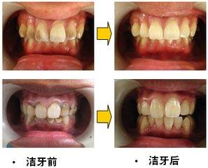 杭州美奧口腔怎么樣？洗牙能去除煙漬嗎