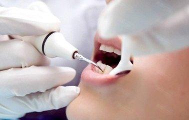 杭州美奧口腔怎么樣？洗牙能去除煙漬嗎
