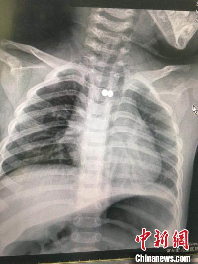 男童誤食兩顆磁力珠 專家通力配合將磁力珠取出-易網<a href=http://m.aoa7937.com/ target=_blank class=infotextkey>健康養(yǎng)生</a>網 男童誤食兩顆磁力珠 專家通力配合將磁力珠取出