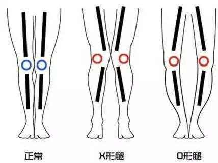 大腿腿型不直有哪些方法可以改善