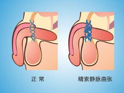 靜脈曲張患者的腿部水腫治療方法