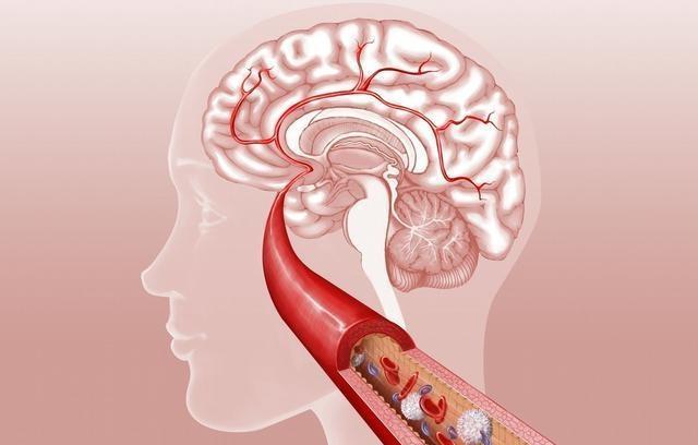 腦血栓患者吃哪些種類藥治療效果好