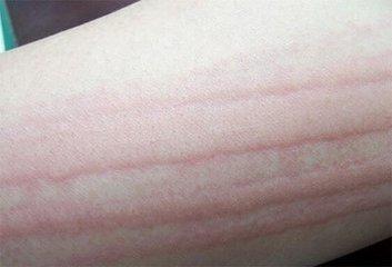 劃痕性蕁麻疹身體需要補(bǔ)充哪些營養(yǎng)