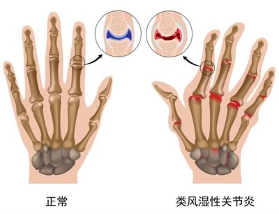 類風濕關節炎高發人群存在著哪些特性