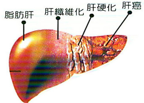 脂肪肝前期表現(xiàn)以及脂肪肝的預(yù)防方法