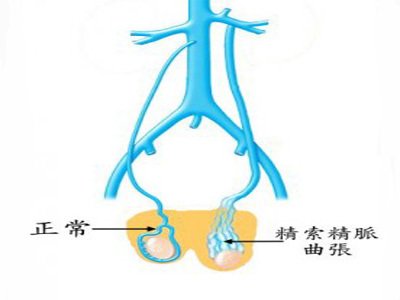 淺靜脈擴張的臨床表現和診斷方法