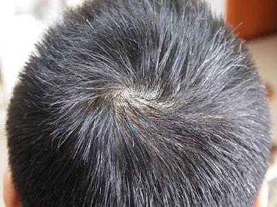 為什么會(huì)有人未老頭發(fā)先白的情況發(fā)生