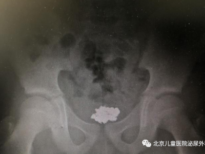 大夫，寶寶把東西塞進(jìn)下面了！怎么辦？