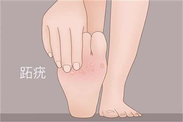 雞眼怎么形成