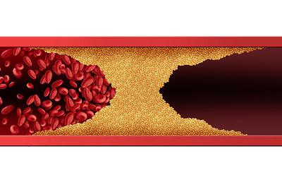 膽固醇高說白了就是缺蛋白質(zhì)嗎 導(dǎo)致膽固醇高的三大原因-易網(wǎng)健康<a href=http://m.aoa7937.com/jkys/ target=_blank class=infotextkey>養(yǎng)生</a>網(wǎng) 膽固醇高說白了就是缺蛋白質(zhì)嗎 導(dǎo)致膽固醇高的三大原因