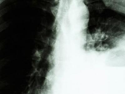肺癌患者可以過性生活嗎？你知道為什么肺癌不傳染嗎？