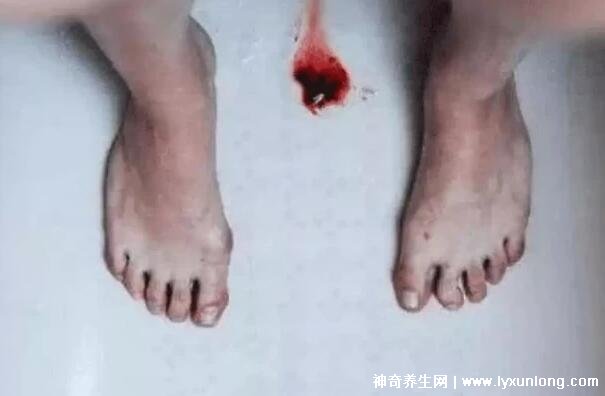 真實(shí)女生內(nèi)膜破壞的圖片，剝脫的子宮內(nèi)膜伴隨經(jīng)血排出