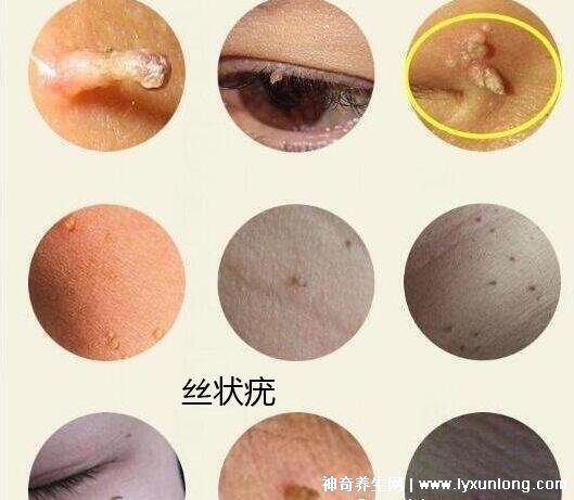 男性疣是什么樣子圖片，尖銳濕疣/扁平疣/絲狀疣發病部位不同