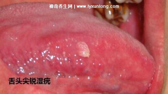 男性早期圖片尖濕銳疣長(zhǎng)在哪，生zhi器甚至是口腔(菜花狀疣體出血)