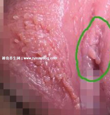 女性假疣和真疣的圖片對比，前者淡紅色和淡褐色魚子狀(5大區別)