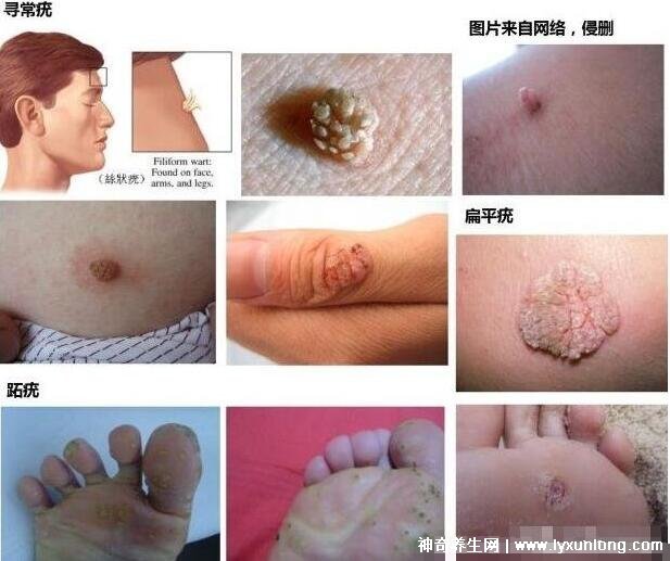男性疣是什么樣子圖片，尖銳濕疣/扁平疣/絲狀疣發病部位不同