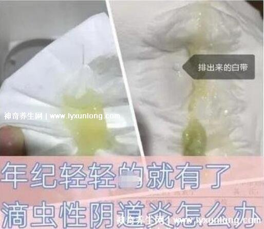 用了甲硝唑后里面長滿了霉菌，破壞有益菌群/衛(wèi)生不佳(附治療法)