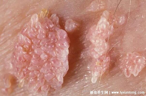 男性疣是什么樣子圖片，尖銳濕疣/扁平疣/絲狀疣發病部位不同