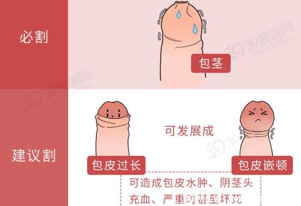 成年男子割包好處和壞處，8種情況必須割(附割包照片真實)