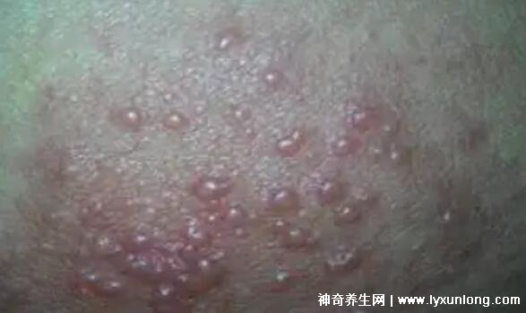 男性疣是什么樣子圖片，尖銳濕疣/扁平疣/絲狀疣發病部位不同