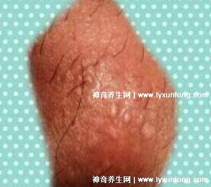 男性早期圖片尖濕銳疣長(zhǎng)在哪，生zhi器甚至是口腔(菜花狀疣體出血)