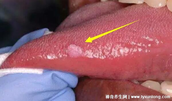 男性早期圖片尖濕銳疣長(zhǎng)在哪，生zhi器甚至是口腔(菜花狀疣體出血)